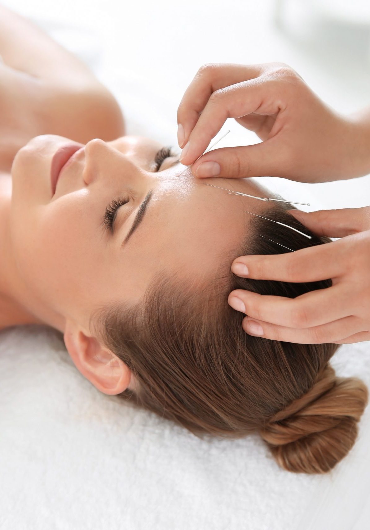 Young woman undergoing acupuncture treatment in salon